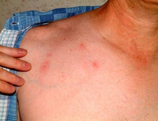 Sintomi di parassiti sotto la pelle